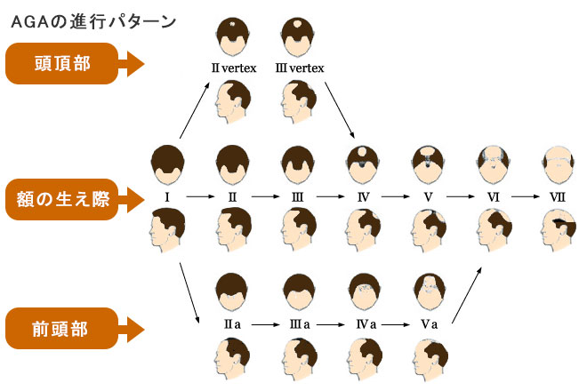 ハミルトンノーウッド分類