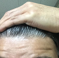 50歳前田さんの生え際
