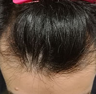 32歳ラジーさんの生え際