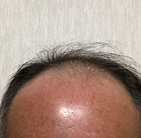 50歳はるぞうさんの生え際