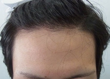生え際の毛が細くなり始めた男性