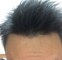26歳いんちゃんさんの生え際