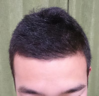 22歳TAITOさんの生え際